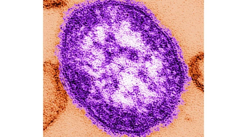 Alabama Health Officials Warn of Measles Case in Huntsville
