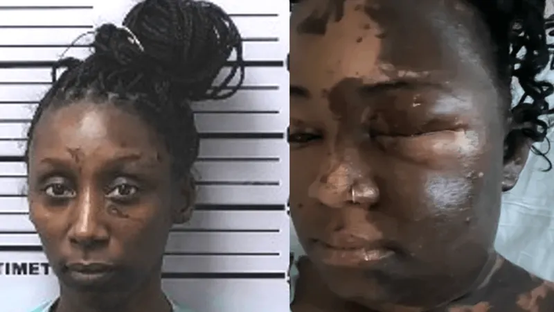 Woman sentenced to 15 years for Mobile acid attack that left victim with 3rd-degree burns