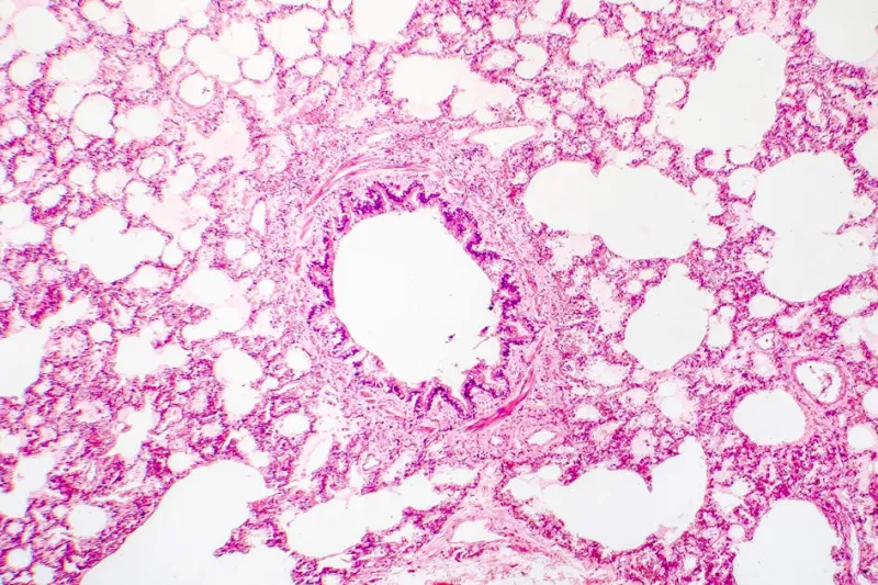 Novel blood test detects rejection after lung transplant