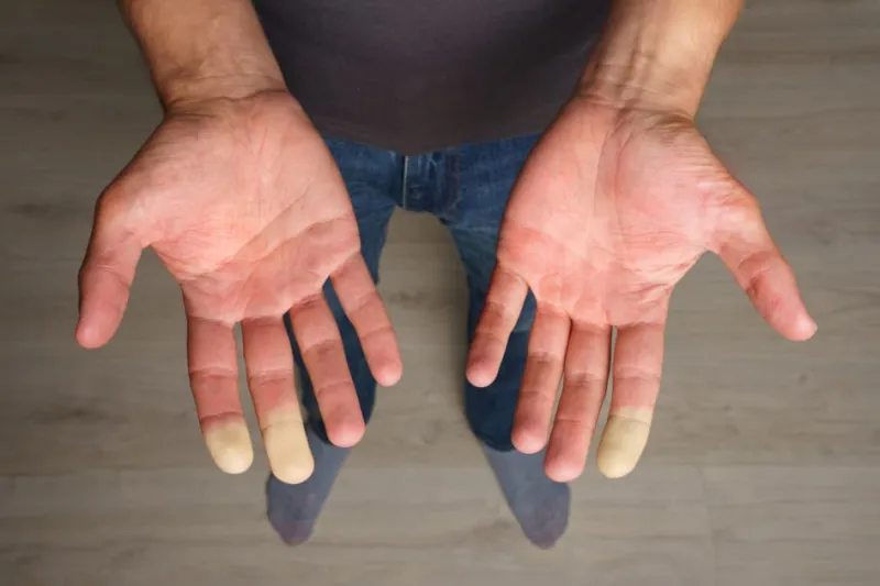 Outpatient Raynaud treatment saves fingers and toes
