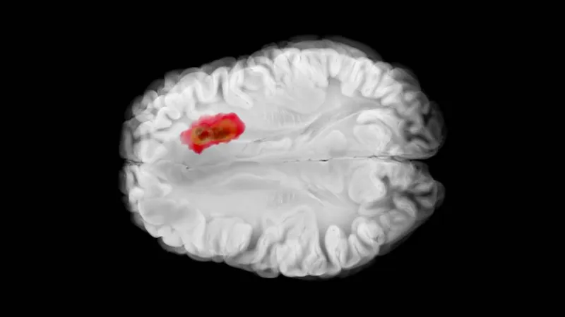 Researchers uncover how an aggressive brain tumor evades treatment