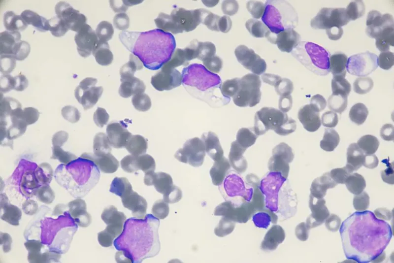 Oral therapy enables at-home treatment for acute myeloid leukemia