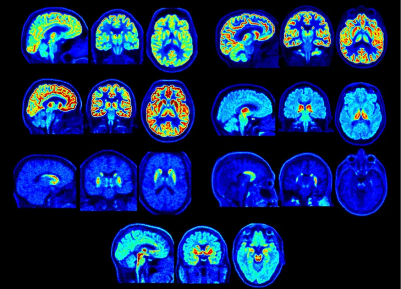 Depression: The hidden toll of Parkinson's disease