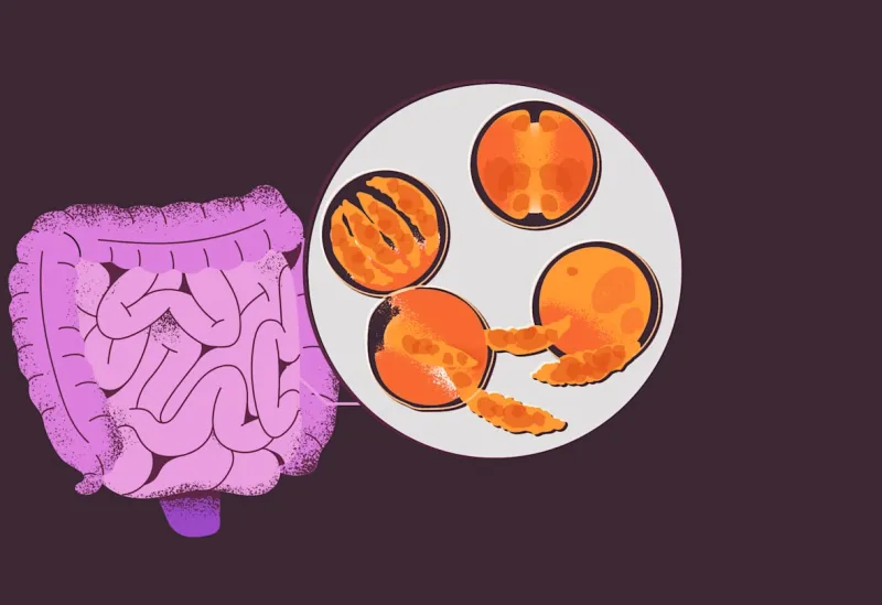 Cyclosporiasis: What to know about the parasitic infection