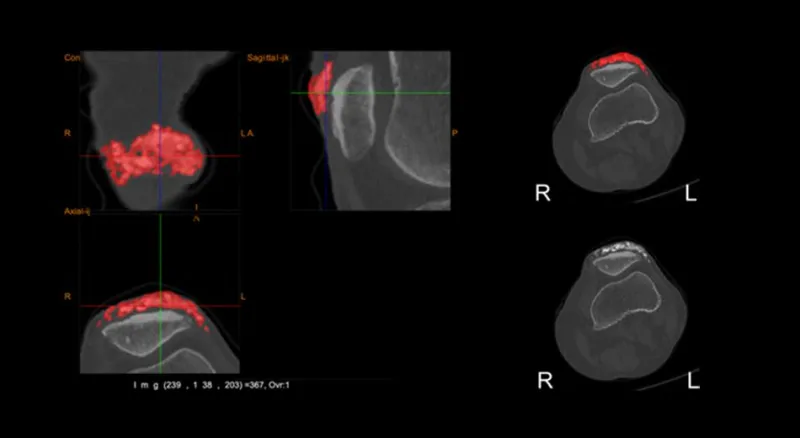 Better measurement for better calcinosis cutis treatment