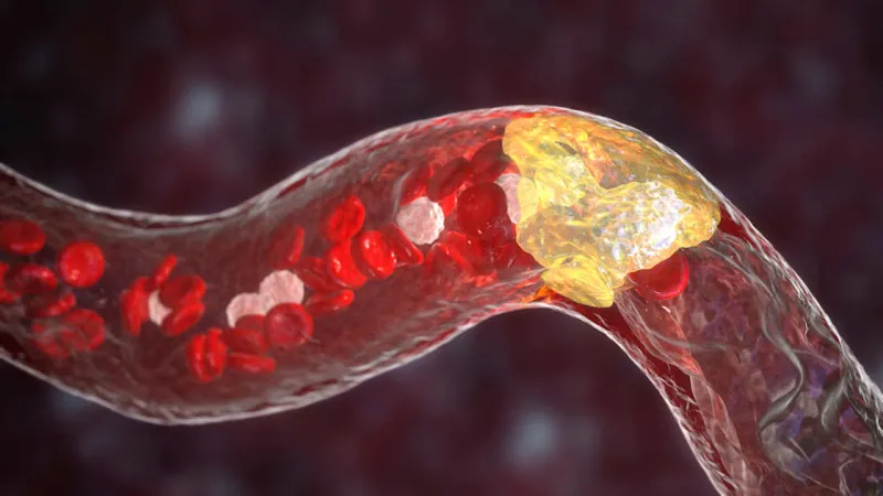 Cancer drug reduces atherosclerosis inflammation and plaque