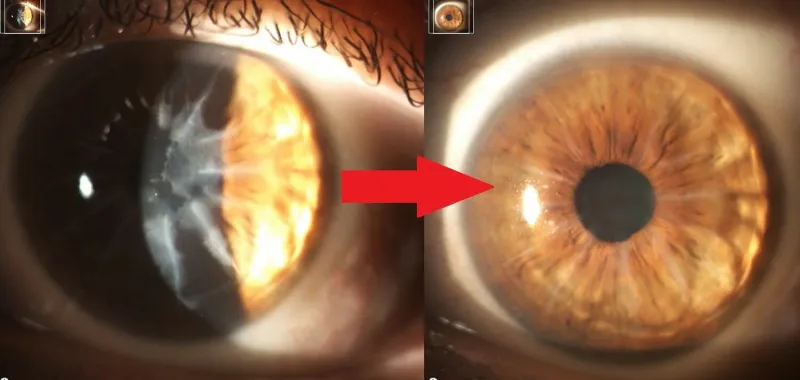 Local eye surgeon's innovation getting international attention