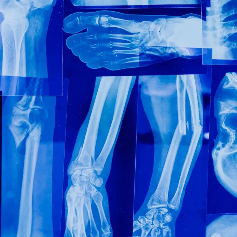 Beyond the break: All about osteoporosis and how to prevent it