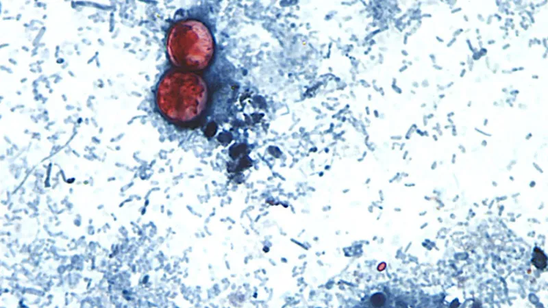 Outbreak of diarrhea from parasite expands to more states as US cases soar beyond last year's level