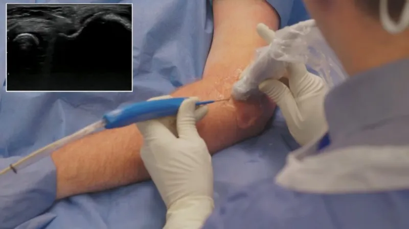 Piedmont offers new treatment for tendon pain