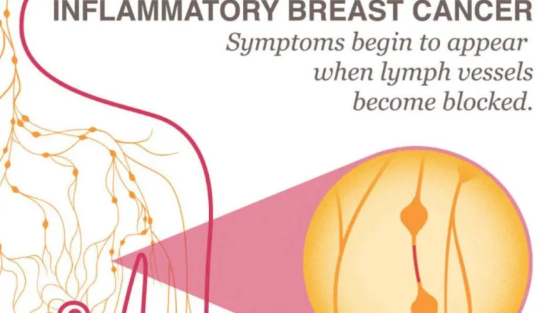 Blood test for highly aggressive form of breast cancer advanced by new research