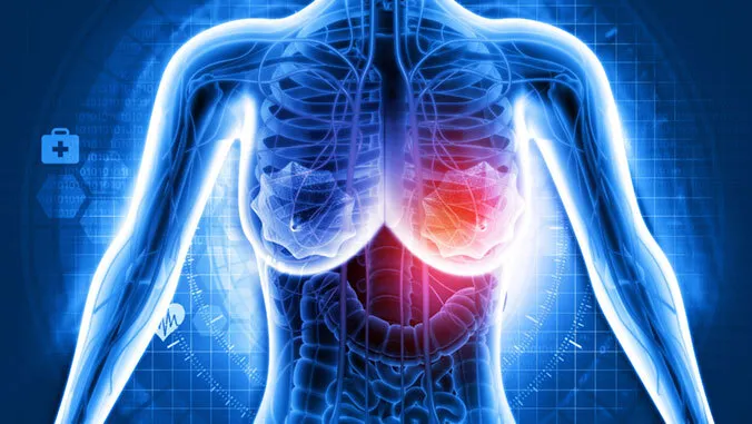 $3M grant to improve risk prediction of pre-invasive breast cancer