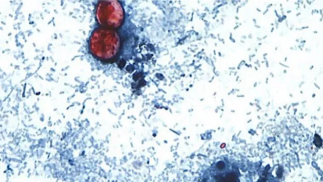 Cyclosporiasis cases top 1,200 in Michigan, health officials say