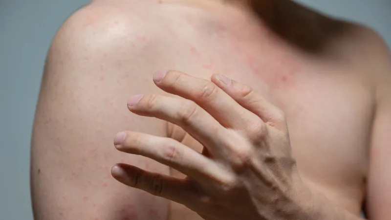 Measles exposure reported at Universal Studios Hollywood
