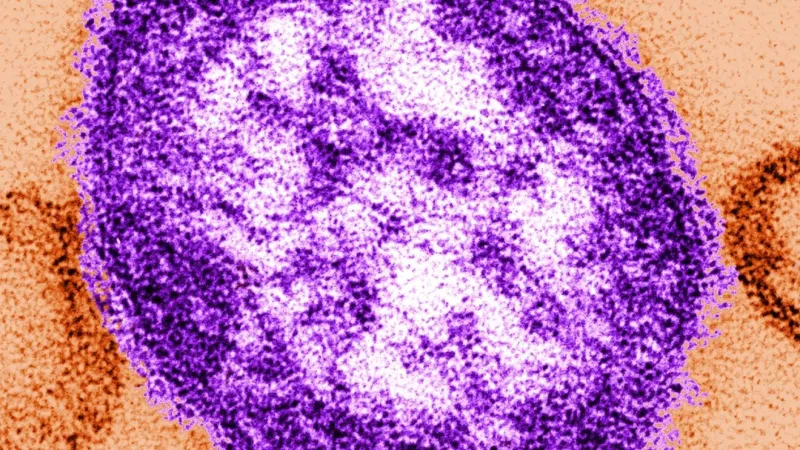 Iowa measles outbreak grows to 16 cases; new Ottumwa exposure reported