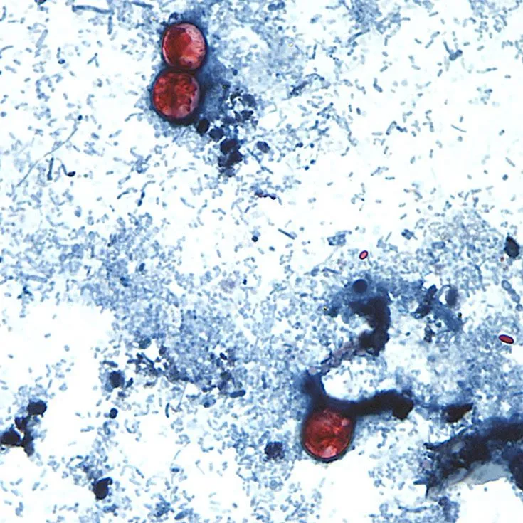 Cyclospora outbreak to be declared over