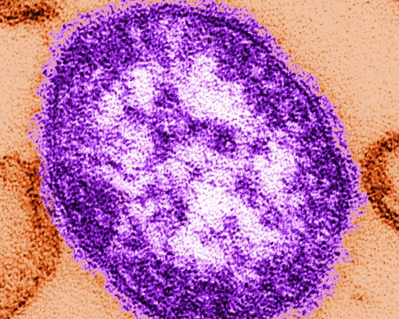 Pennsylvania tallies a fifth death related to measles as outbreak approaches a thousand cases