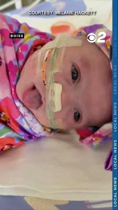 Micropreemie born at 25 weeks nears due date after 3 months in NICU (Video)