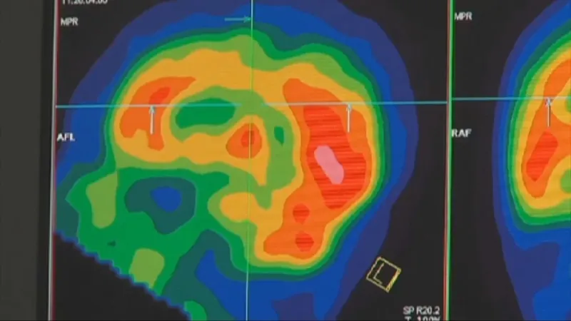 Neurologists urge earlier brain health steps ahead of World Alzheimer's Month