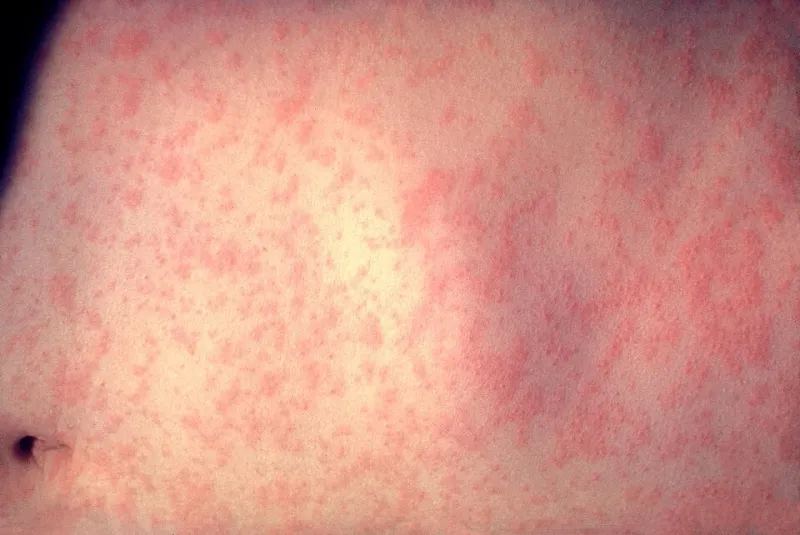 THIRD MEASLES CASE CONFIRMED IN WAYNE COUNTY