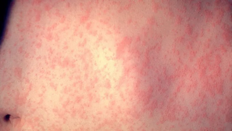 Measles reported in LaGrange County, first cases in Northern Indiana