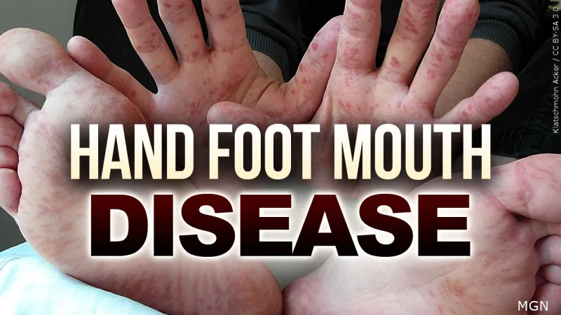 Several cases of hand, foot, and mouth disease reported at Stewart Elementary School