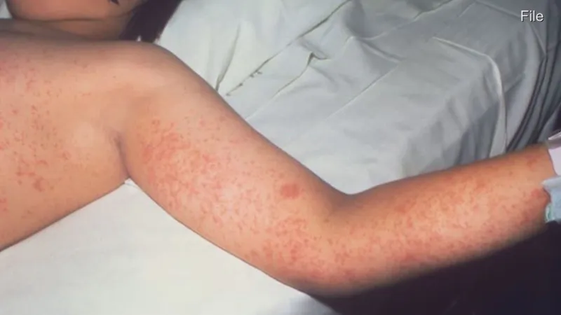 Measles on the rise, officials urge MMR vaccine to prevent infection