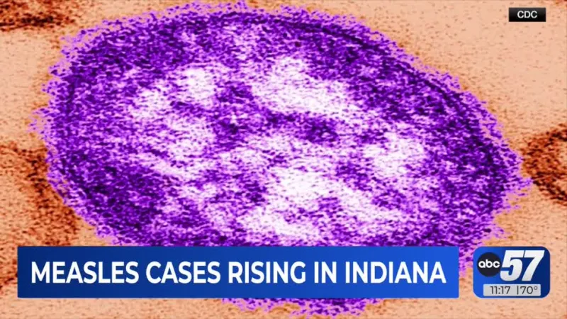 Measles cases rising in Indiana