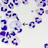 Ruston girl dies after battling rare brain-eating amoeba infection