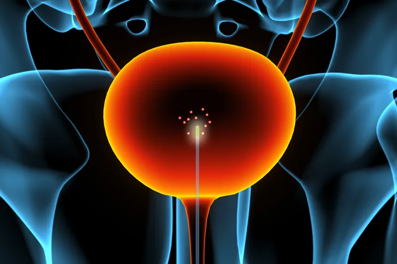 A new sensor could enable earlier detection of bladder cancer
