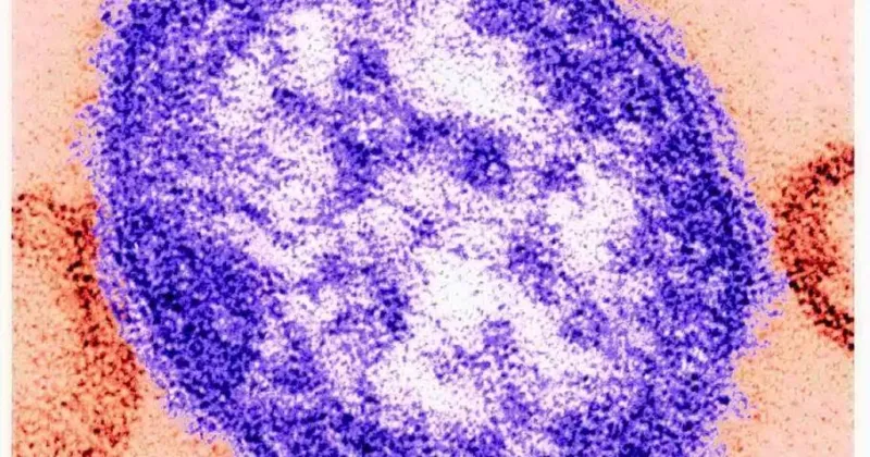 Measles case confirmed in Fillmore County