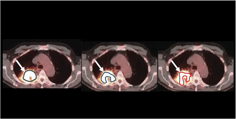 Technique evaluates reliability of imaging measurements used in medical decision-making