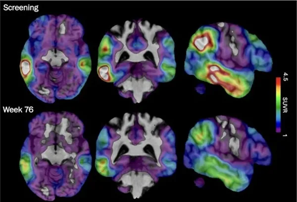 An experimental Alzheimer's drug shows promise targeting a different brain protein, new study shows