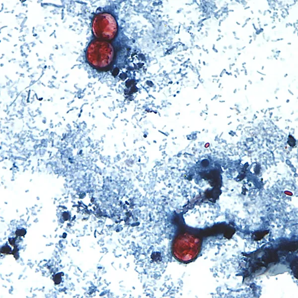 Two cases of cyclosporiasis reported in Mississippi