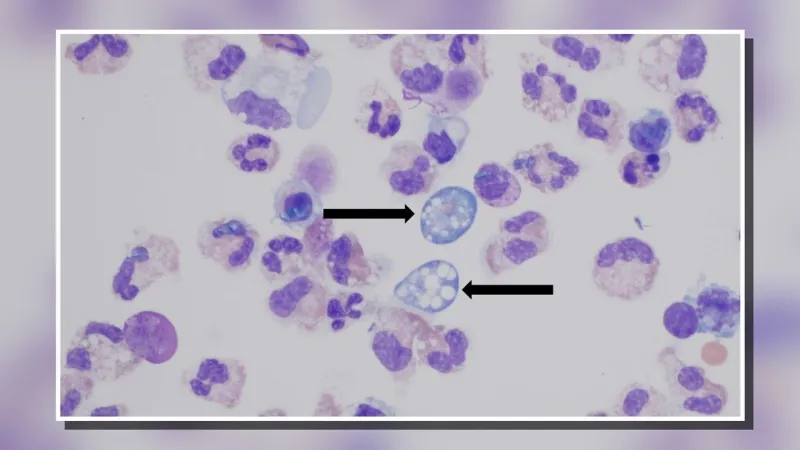 Central North Carolina teen critically ill with rare brain eating amoeba infection