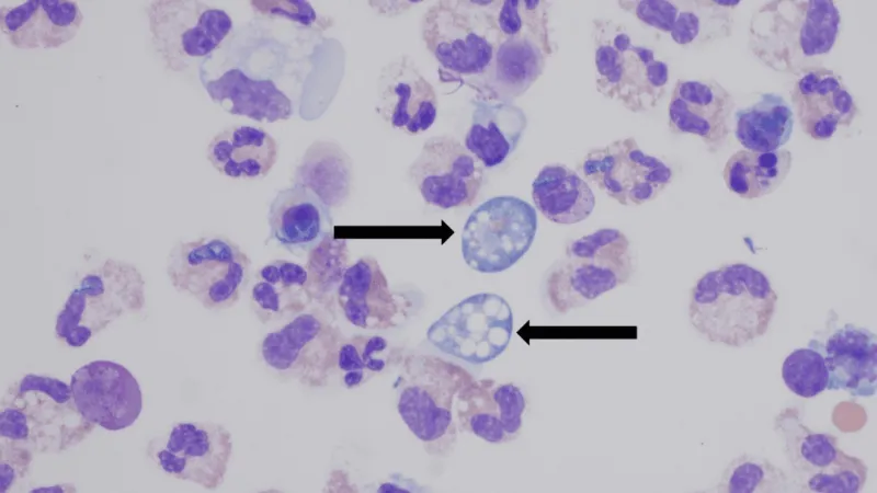 NCDHHS: Central North Carolina teen dies after rare amoeba infection