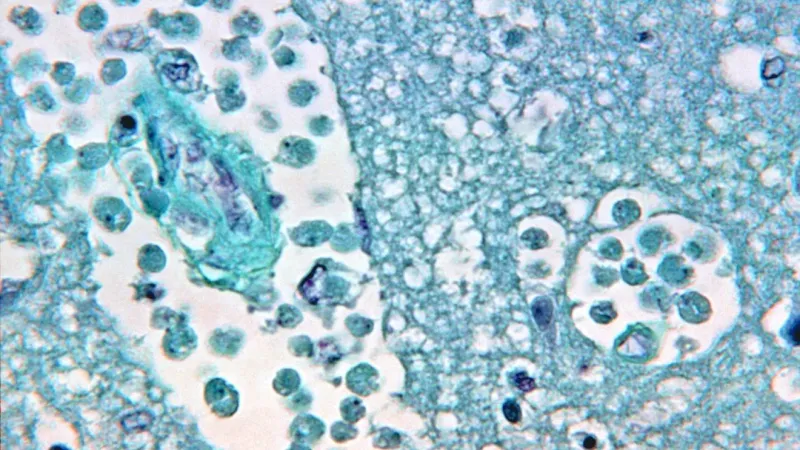 Health officials identify 'likely source' of rare brain infection that killed NC teen
