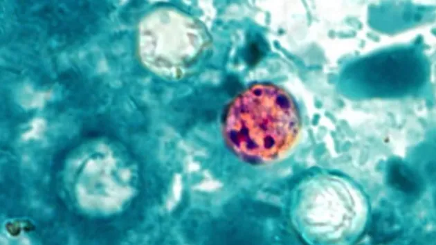 What you need to know about cyclosporiasis: How it spreads, how it's treated