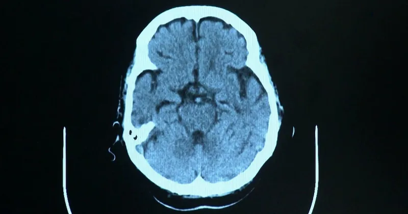Newark, N.J., community has "astonishingly high number" of people with early signs of dementia, researchers say