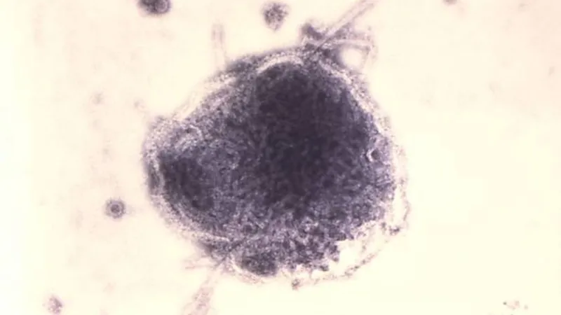 Health alert: First measles case of 2026 reported in Amarillo area