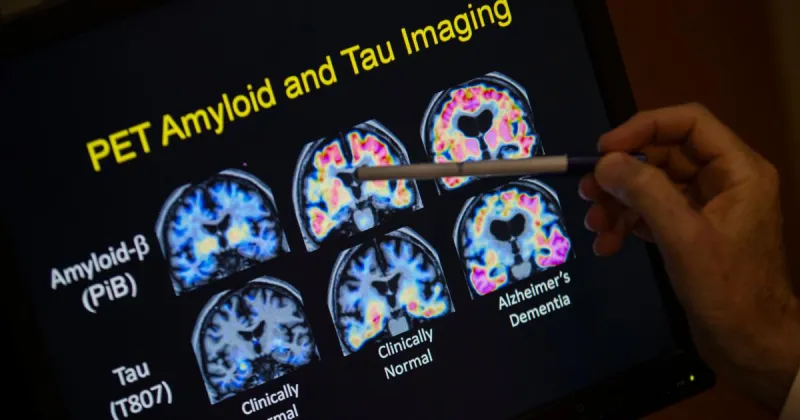 Want to lower your risk of dementia? It doesn't involve a blood test