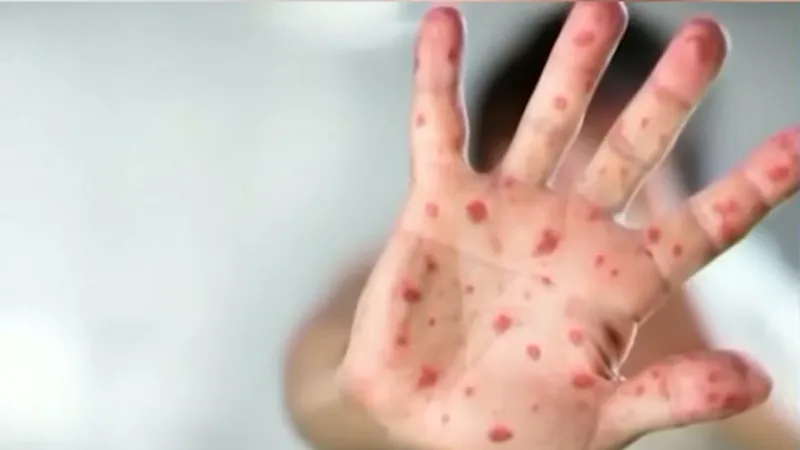 Measles cases rise nationwide; Texas has no active outbreak