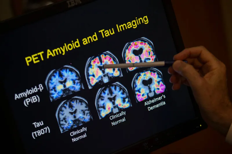 Want to lower your risk of dementia? It doesn't involve a blood test