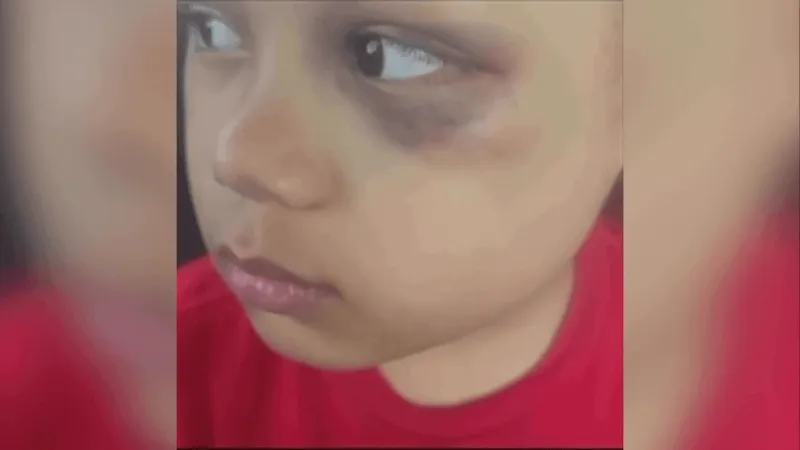 Tulsa family searching for answers after child with autism suffers black eye at school