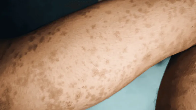 Health officials warn of new measles exposure site at Kaiser Mt. Scott in Clackamas