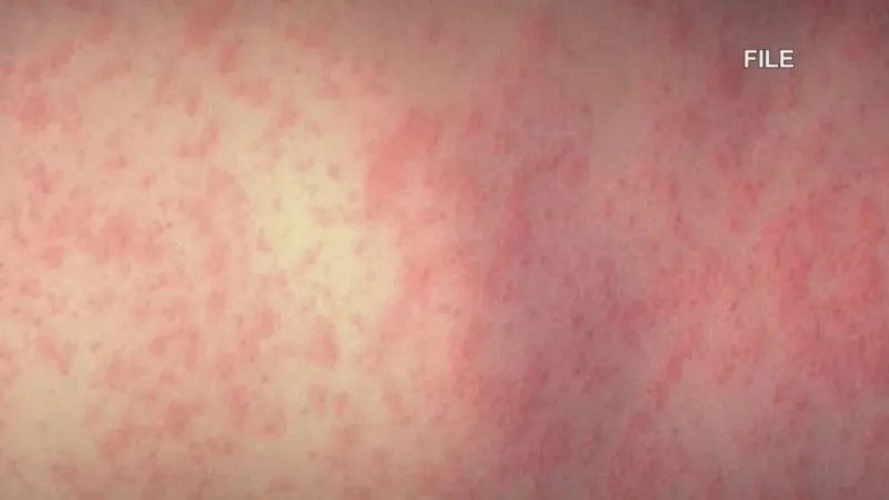 Gresham's Legacy Mount Hood Medical Center confirmed measles exposure site