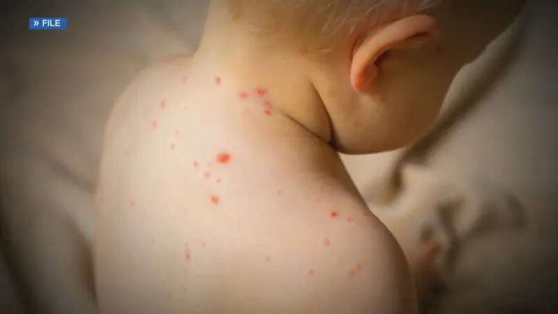 Oregon measles cases hit highest level in decades as vaccination rates fall