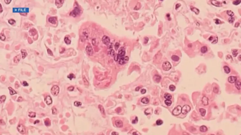 New measles exposure site confirmed at Kaiser Permanente Sunnyside in Clackamas