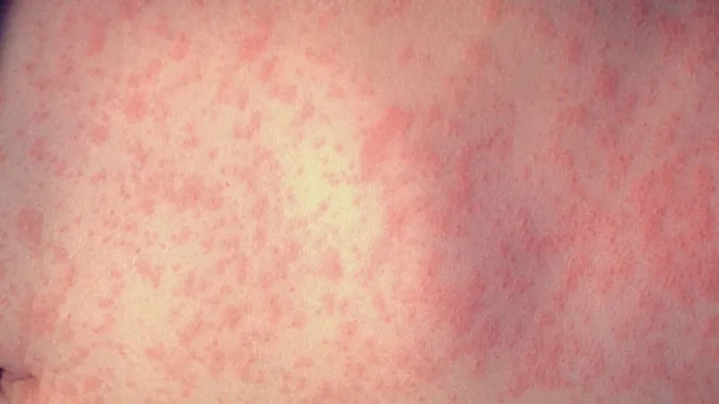 OHA reports new measles exposures at 3 Portland-area clinics, hospitals