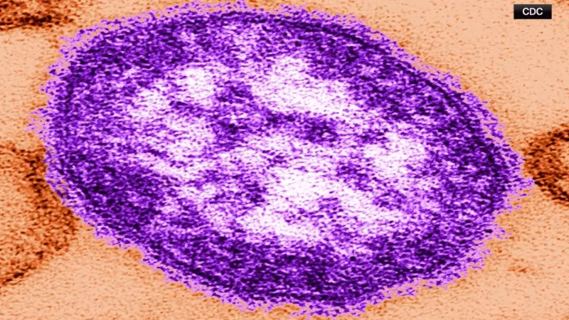 PA woman dies of measles-related complications, Jefferson County Coroner reports